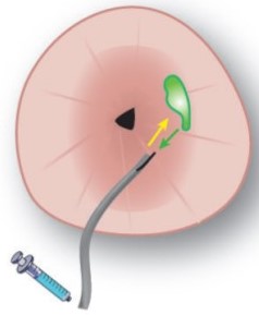 Topical fluorescent guided endoscopy | OMIG
