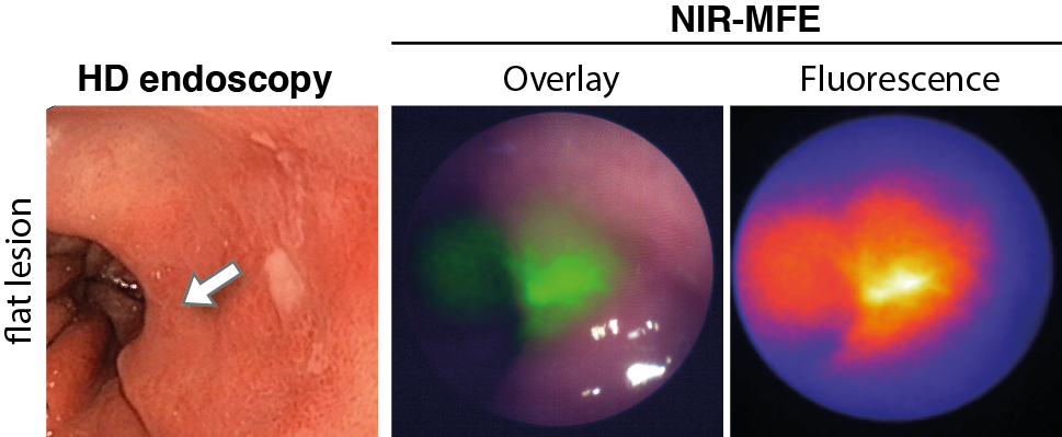 Fluorescence molecular endoscopy | OMIG