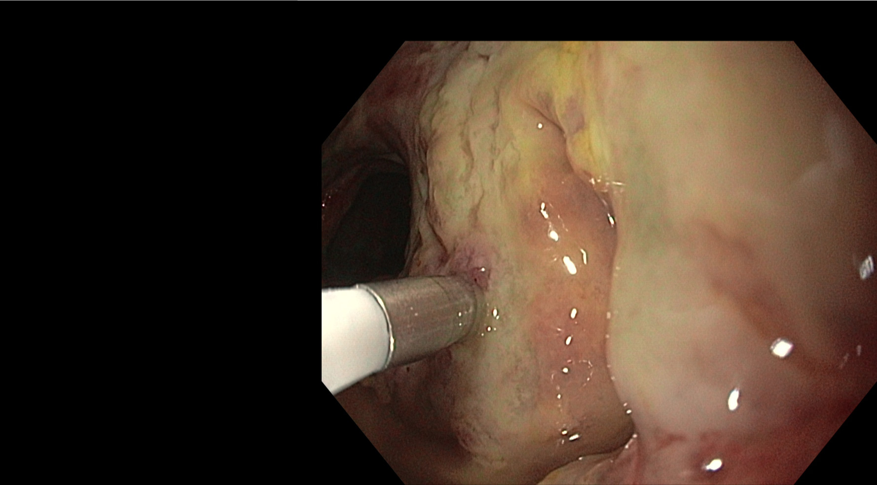 Endoscopic spectroscopy | OMIG