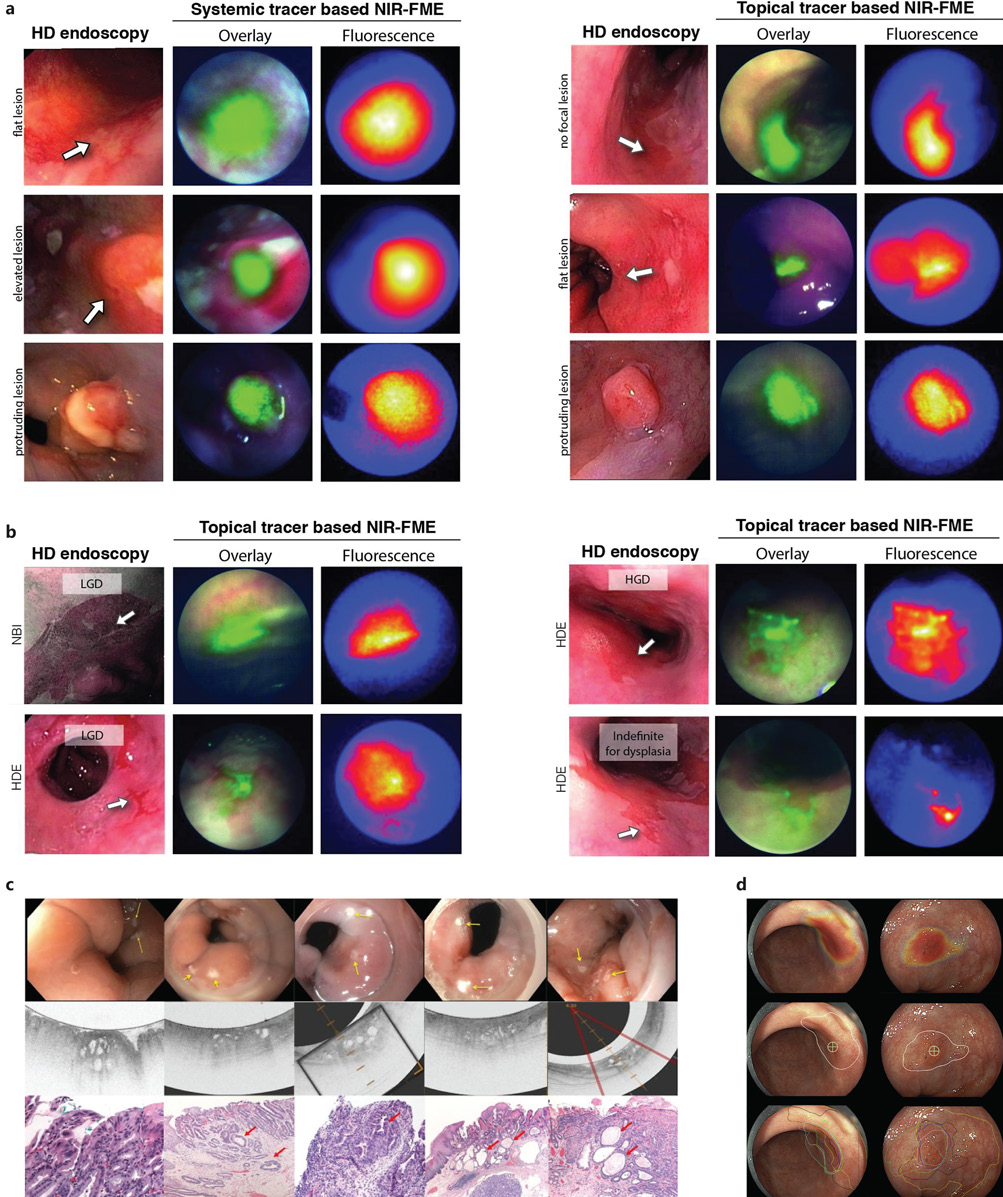 Different lesion types of Barret's esophagus visualized with FME and the tracer Bevacizumab | OMIG
