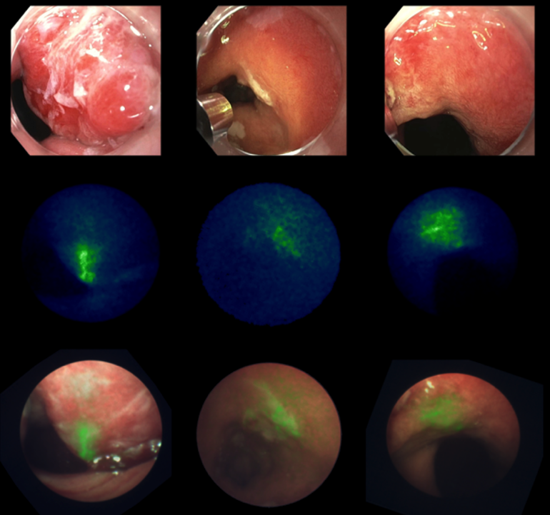 Fluorescence Endoscopy