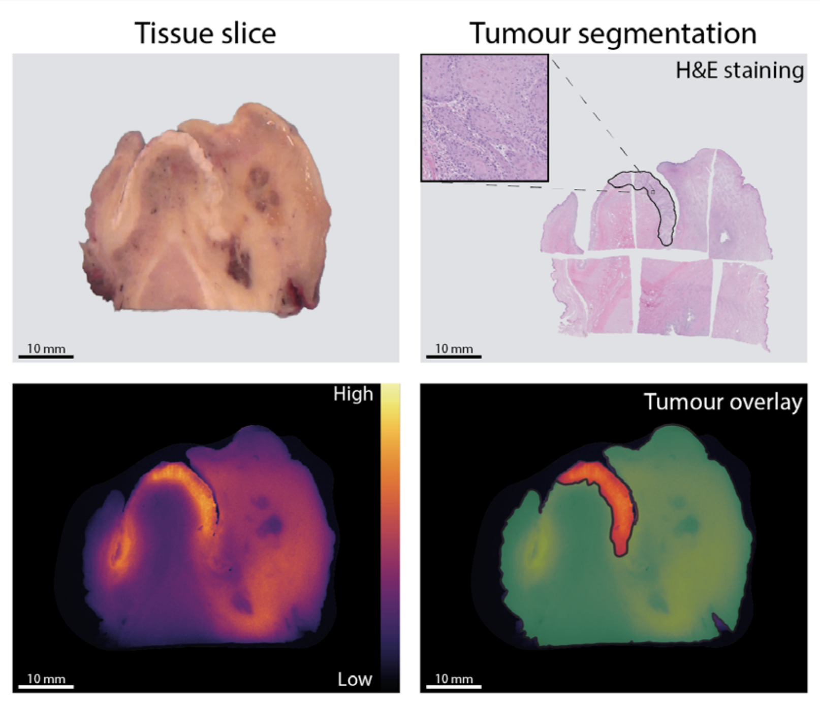 Tissue slices. Pathology confirmed tumor tissue (red) and healthy tissue (green)